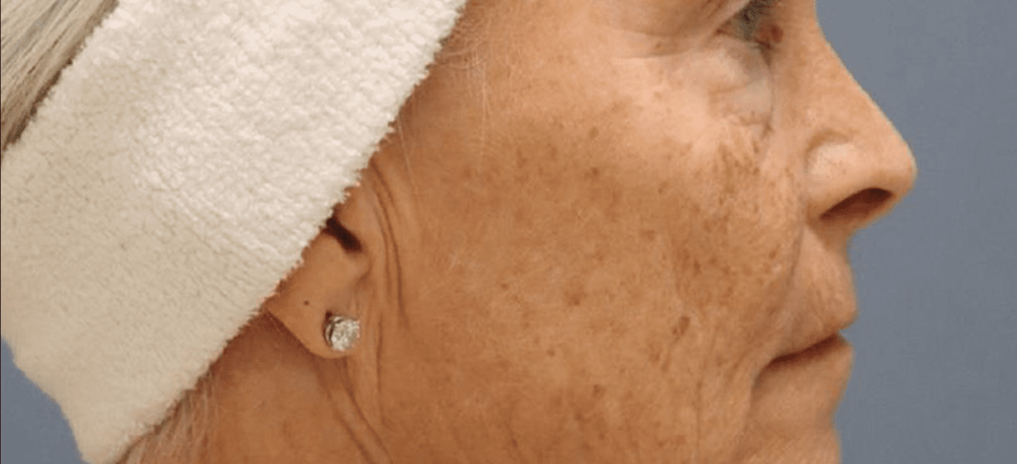 Profile of woman before and after microneedling RF-after
