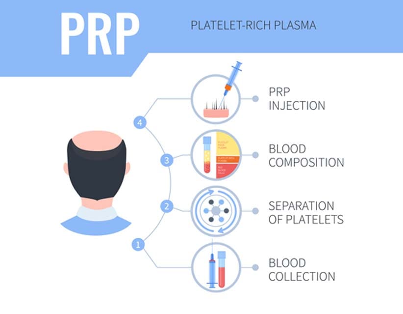 concept-of-hair-restoration-with-PRP-in-Irvine-New-Skin-Body-Aesthetics