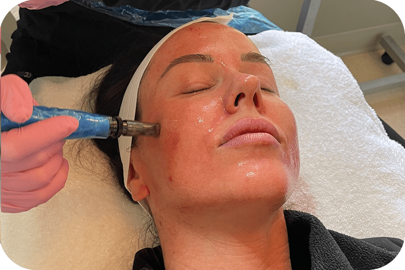 microneedling-treatment-with-rejuvapen-scaled