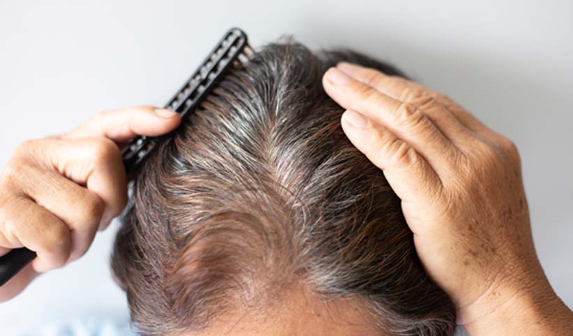 patient-seeking-hair-restoration-with-PRP-in-Irvine-New-Skin-Body-Aesthetics